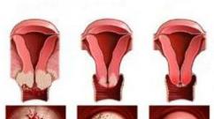 Eroziunea cervicală poate să dispară de la sine și în ce cazuri se întâmplă acest lucru?